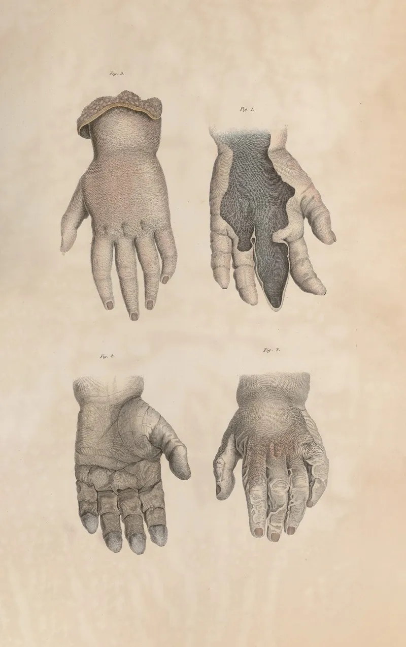 A System Of Anatomical Plates Of The Human Body Pl 085 Wall Art by John Lizars - High-Resolution Digital Print