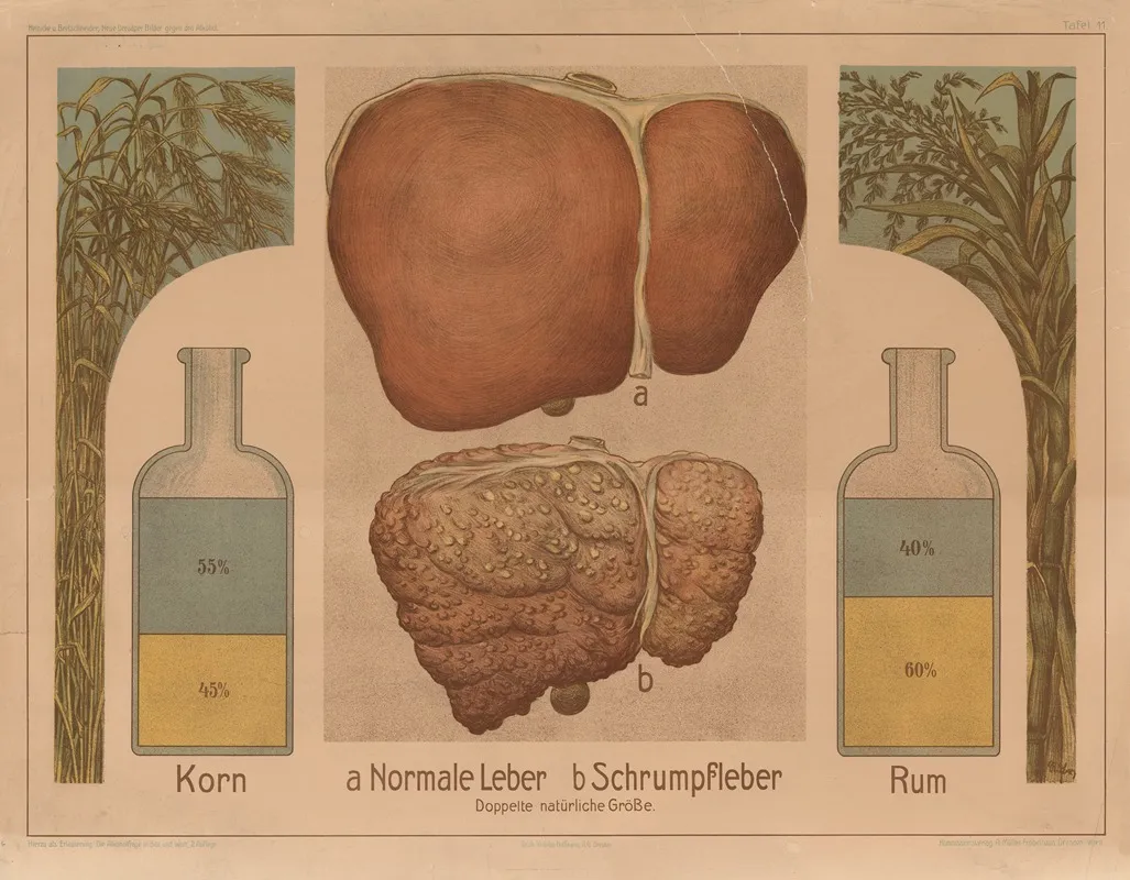 Alcohol Normal Liver And Cirrhosis Wall Art by Wilhelm Hoffmann, A.G. - High-Resolution Digital Print