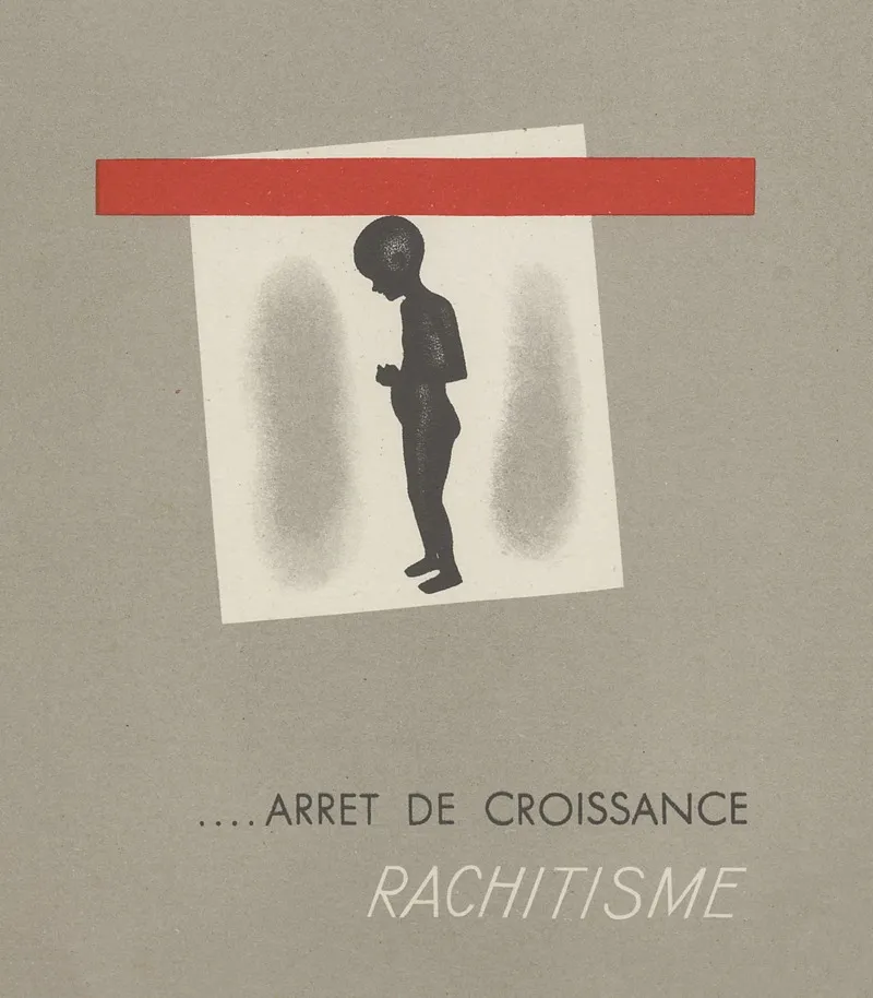 Arret De Croissance Rachitisme