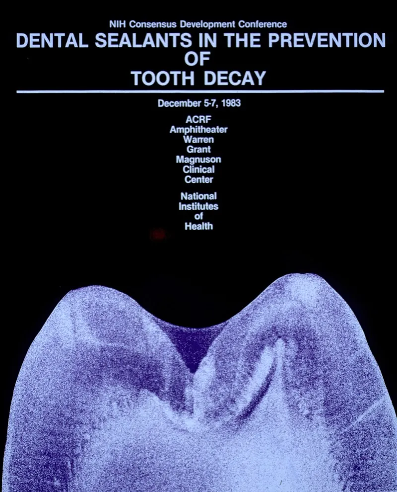 Dental Sealants In The Prevention Of Tooth Decay