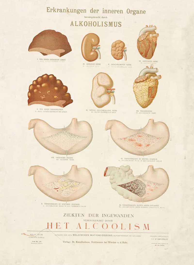 Diseases Of The Internal Organs Caused By Alcoholism Wall Art by Dr. van Coillie - High-Resolution Digital Print