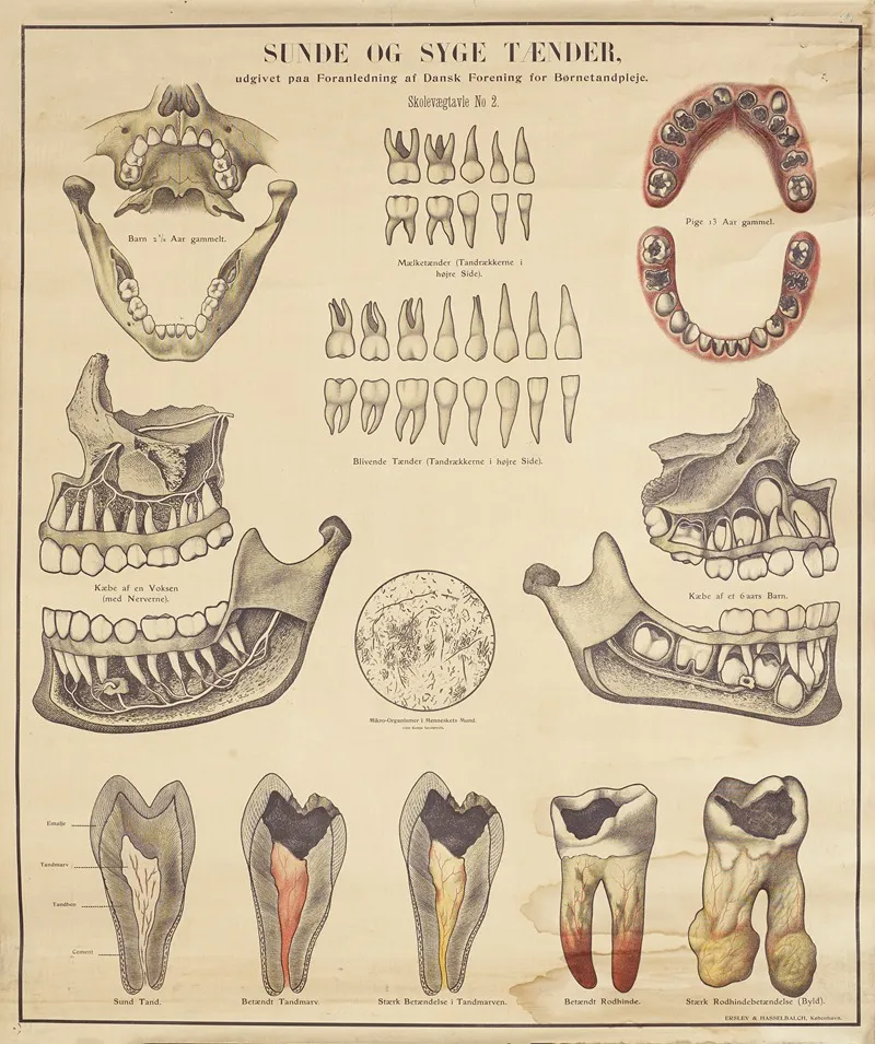 Healthy And Unhealthy Teeth Wall Art by Erslev & Hasselbalch - High-Resolution Digital Print