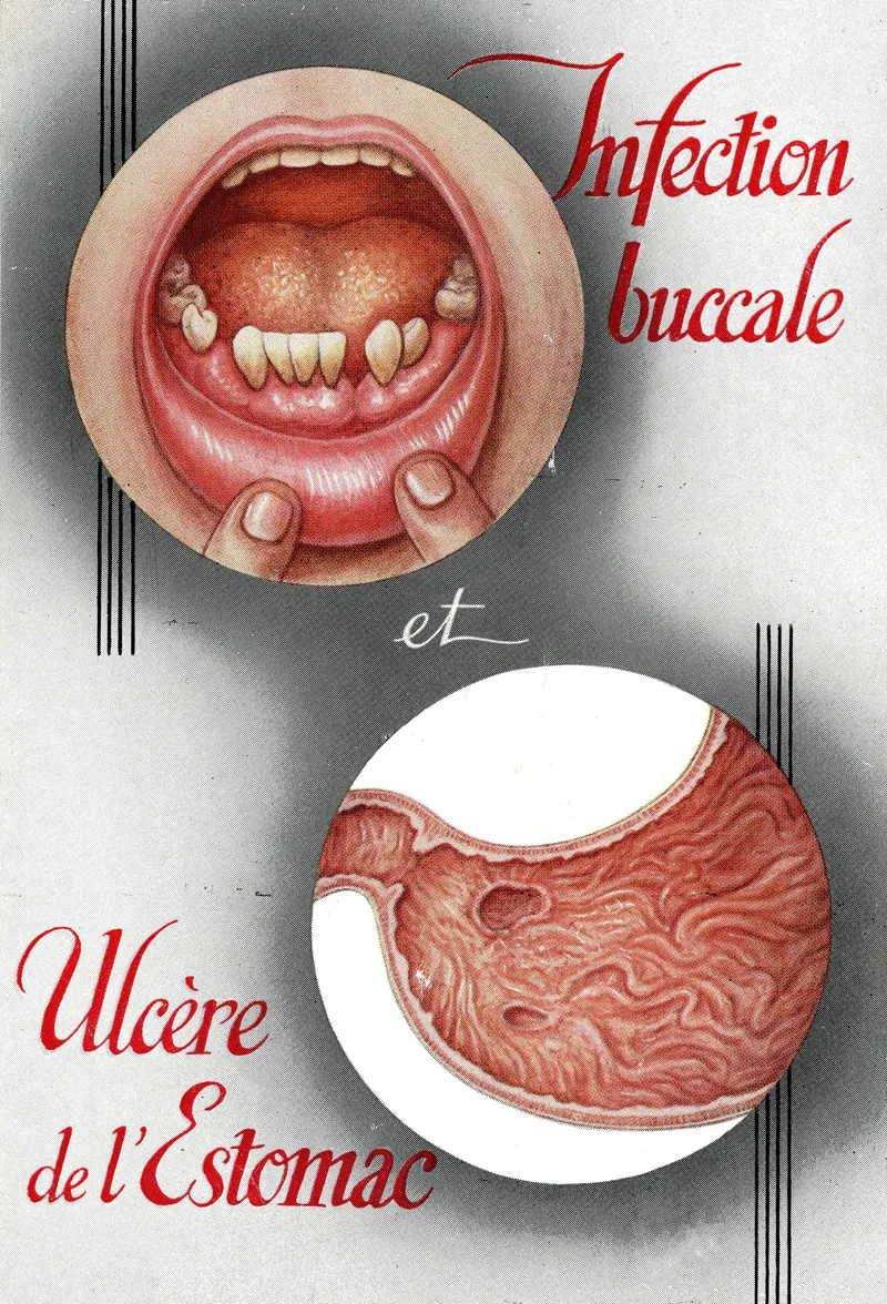 Infection Buccale Et Ulcere De Lestomac
