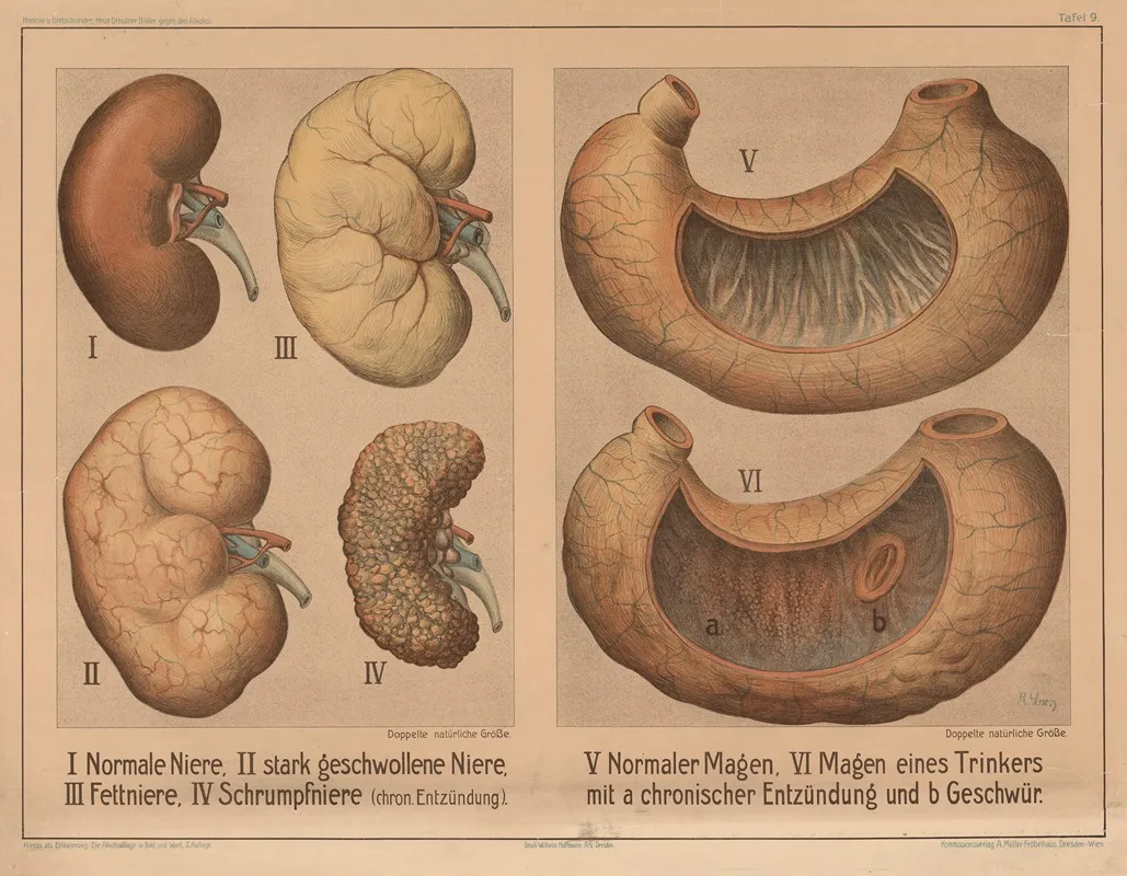 Kidneys And Stomach In Healthy And Diseased States Wall Art by Wilhelm Hoffmann, A.G. - High-Resolution Digital Print