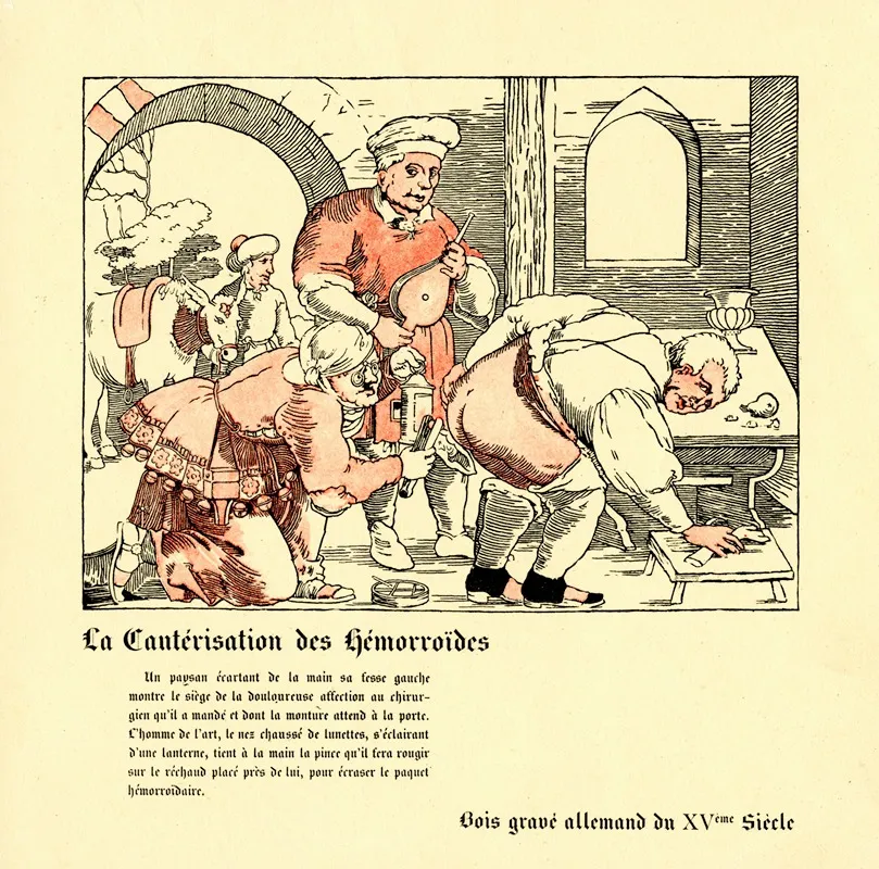 La Cauterisation Des Hemorroides 2 Wall Art by Bénic - High-Resolution Digital Print