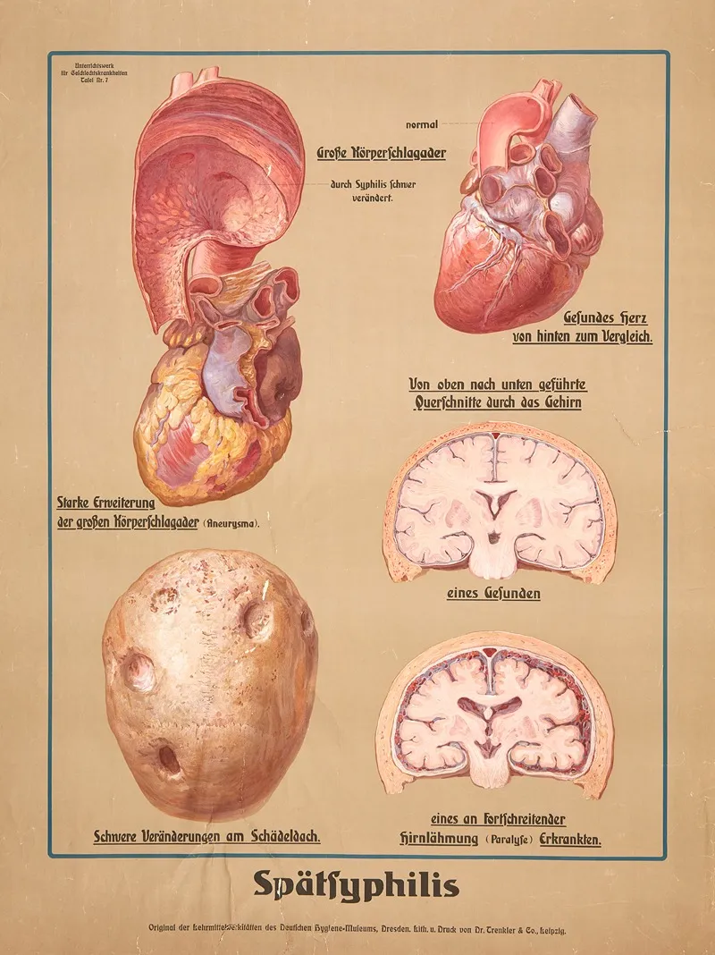 Late Syphilis Effects