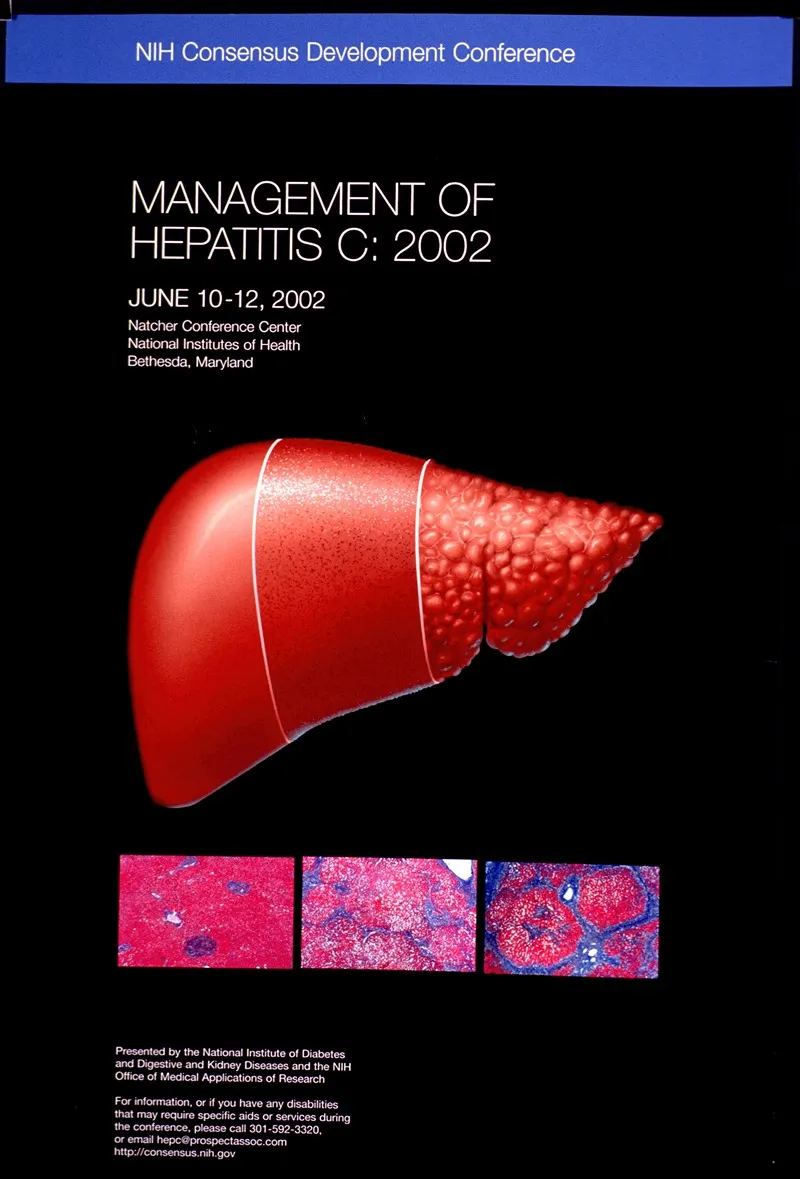Management Of Hepatitis C