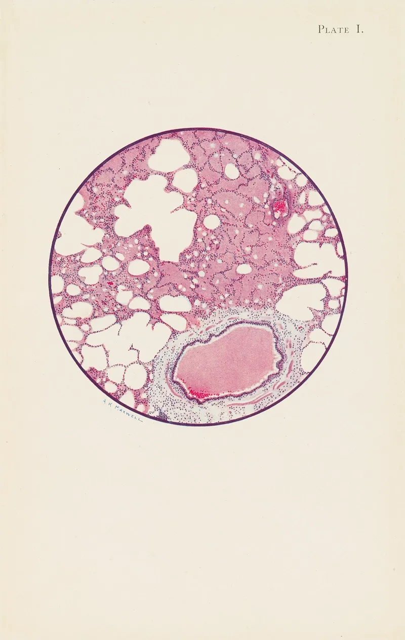 Plate I Microscopic Section Of Human Lung From Phosgene Shell Poisoning Death At The Nineteenth Hour After Gassing