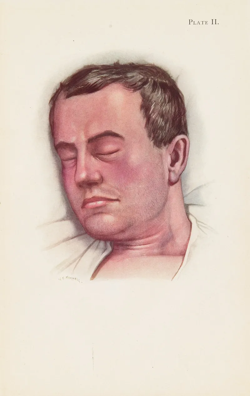 Plate Ii Blue Type Of Asphyxia From Phosgene Poisoning With Intense Venous Congestion