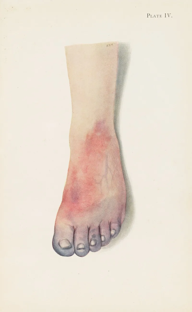 Plate Iv Gangrene Of Foot Caused By Vascular Thrombosis From Chlorine Poisoning