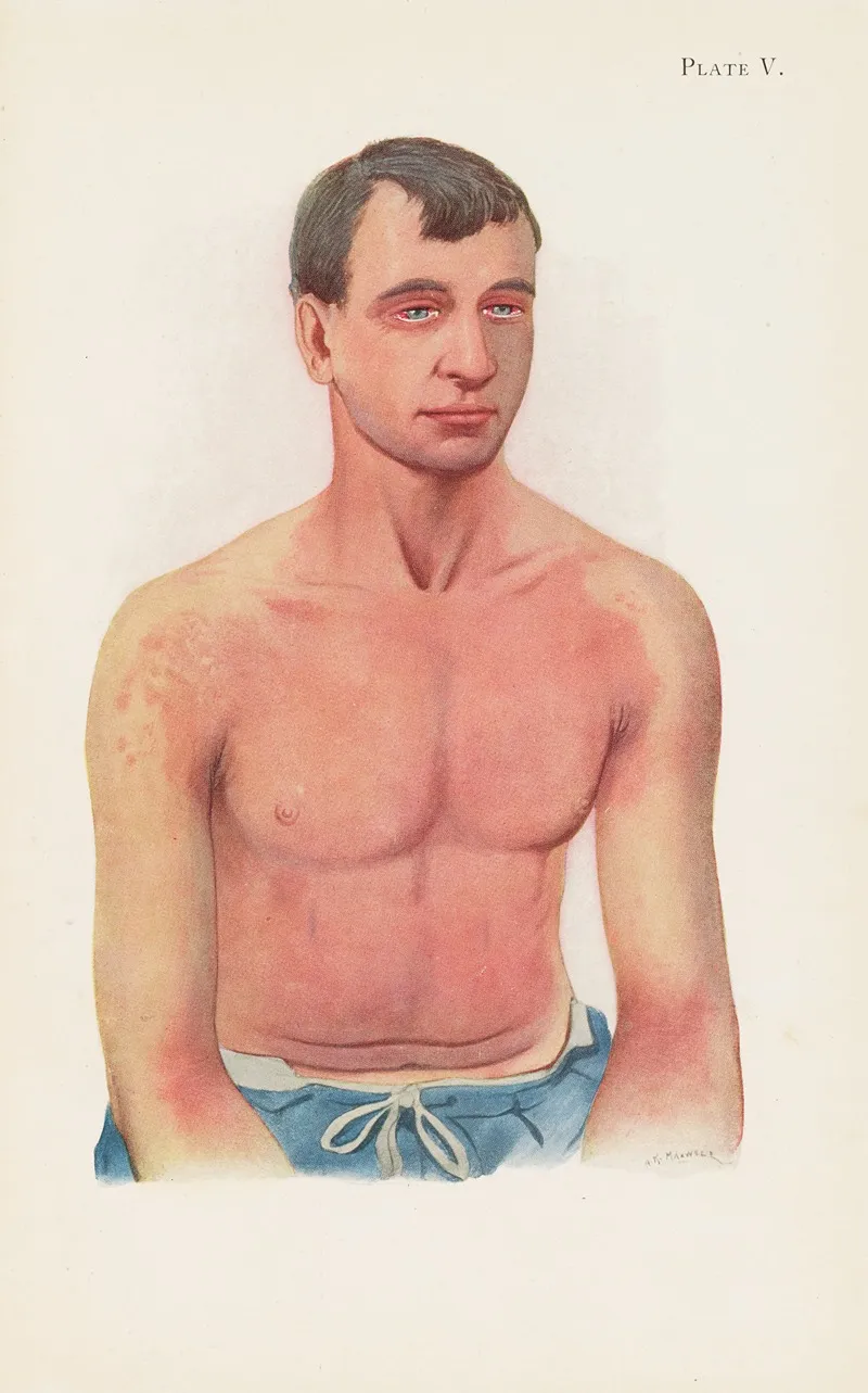 Plate V Erythema Of Skin From General Exposure To The Vapour Of Yellow Cross Substance