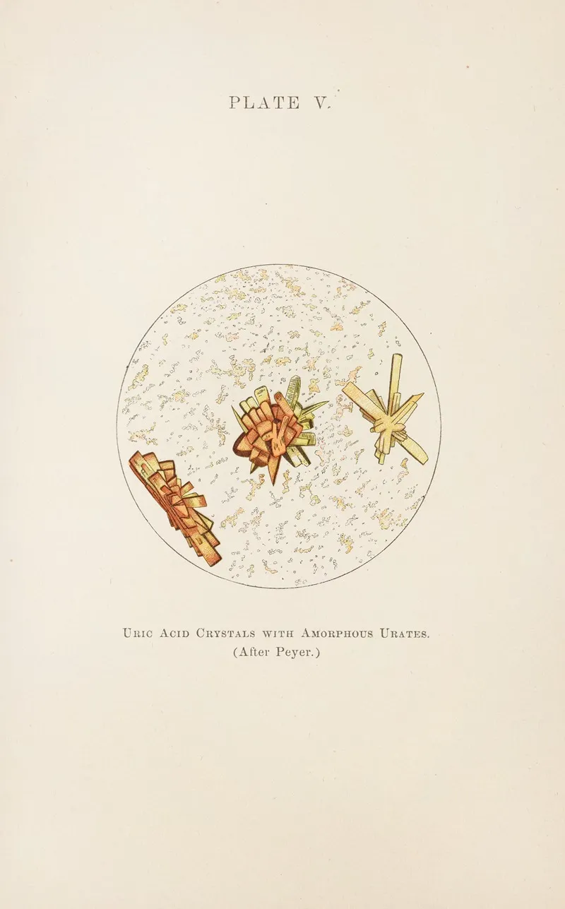 Plate V Uric Acid Crystals With Amorphous Urates Wall Art by Charles Wesley Purdy - High-Resolution Digital Print