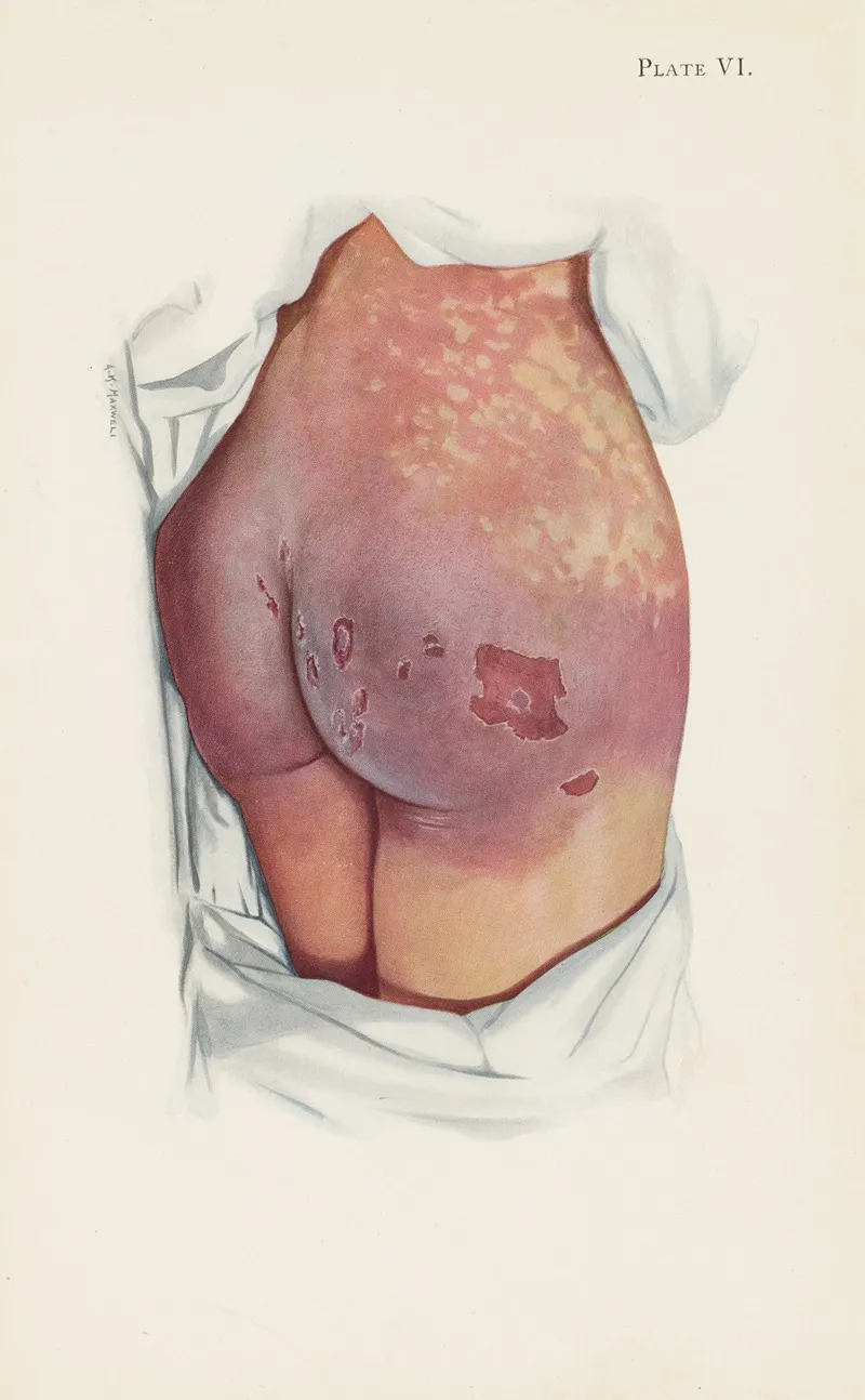 Plate Vi Blistering Of Buttocks By Mustard Gas