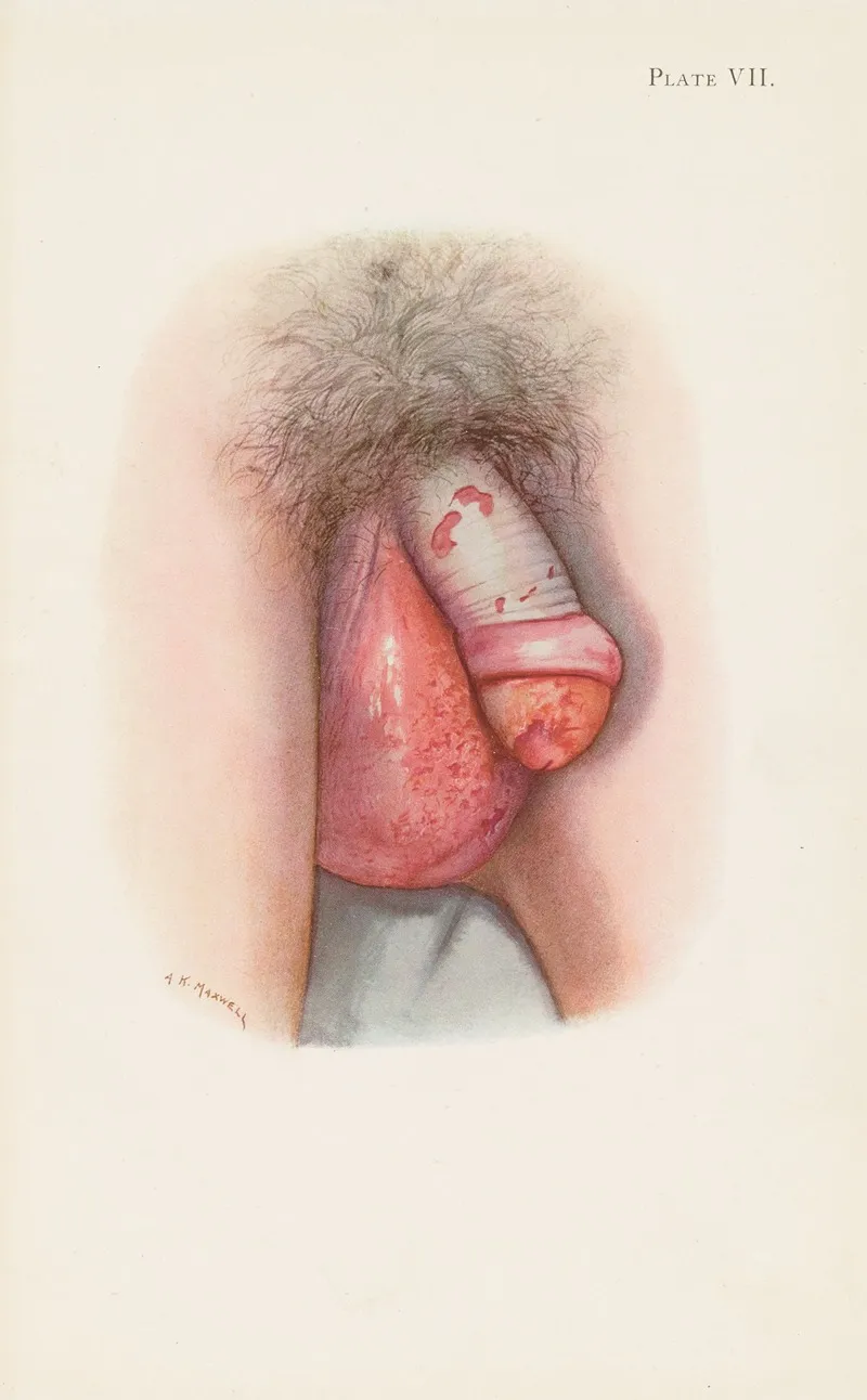 Plate Vii Burning Of Scrotum And Penis By Mustard Gas