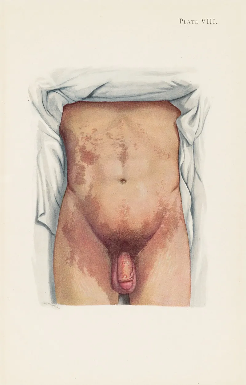 Plate Viii Brown Staining From Mustard Gas