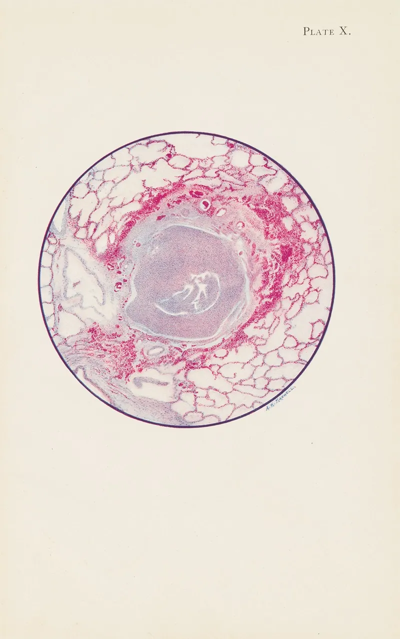 Plate X Microscopic Section Of Human Lung From Mustard Gas Poisoning With Death At End Of Second Day 40 Hours