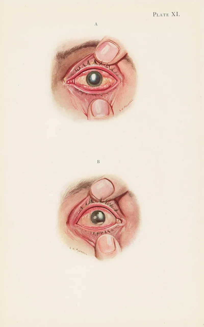 Plate Xi A Severely Burned Eye In The Acute Stage B Slightly Later Stage Of Acute Burning