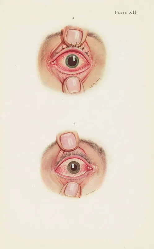 Plate Xii A Stage Of Resolution After Severe Burning B Late Stage Of Resolution