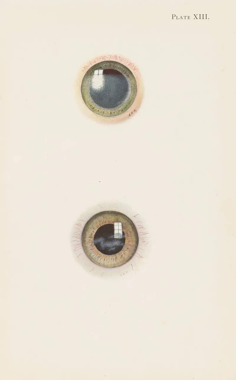 Plate Xiii A Drawing Of The Cornea In The Acute Stage Of Severe Burning B Drawing Of Cornea In The Stage Of Resolution After Severe Burning