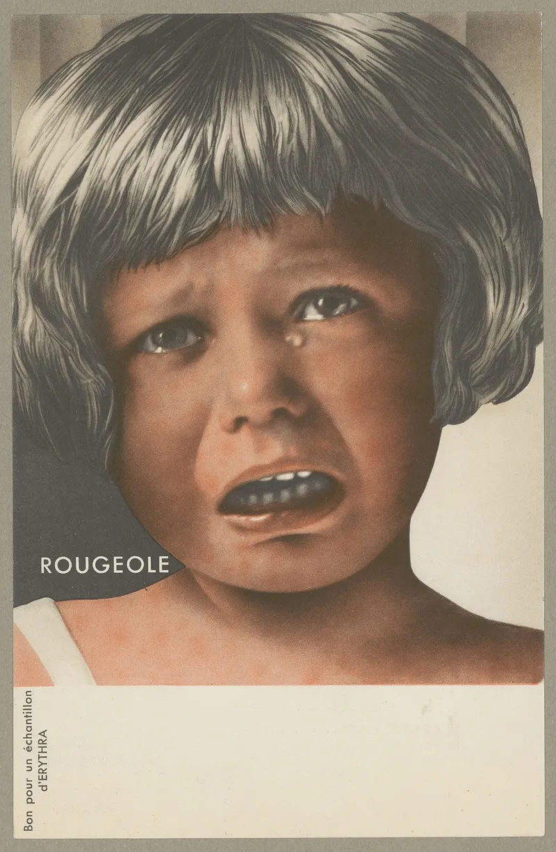 Rougeole Erythra Wall Art by Société d'applications pharmacodynamiques - High-Resolution Digital Print