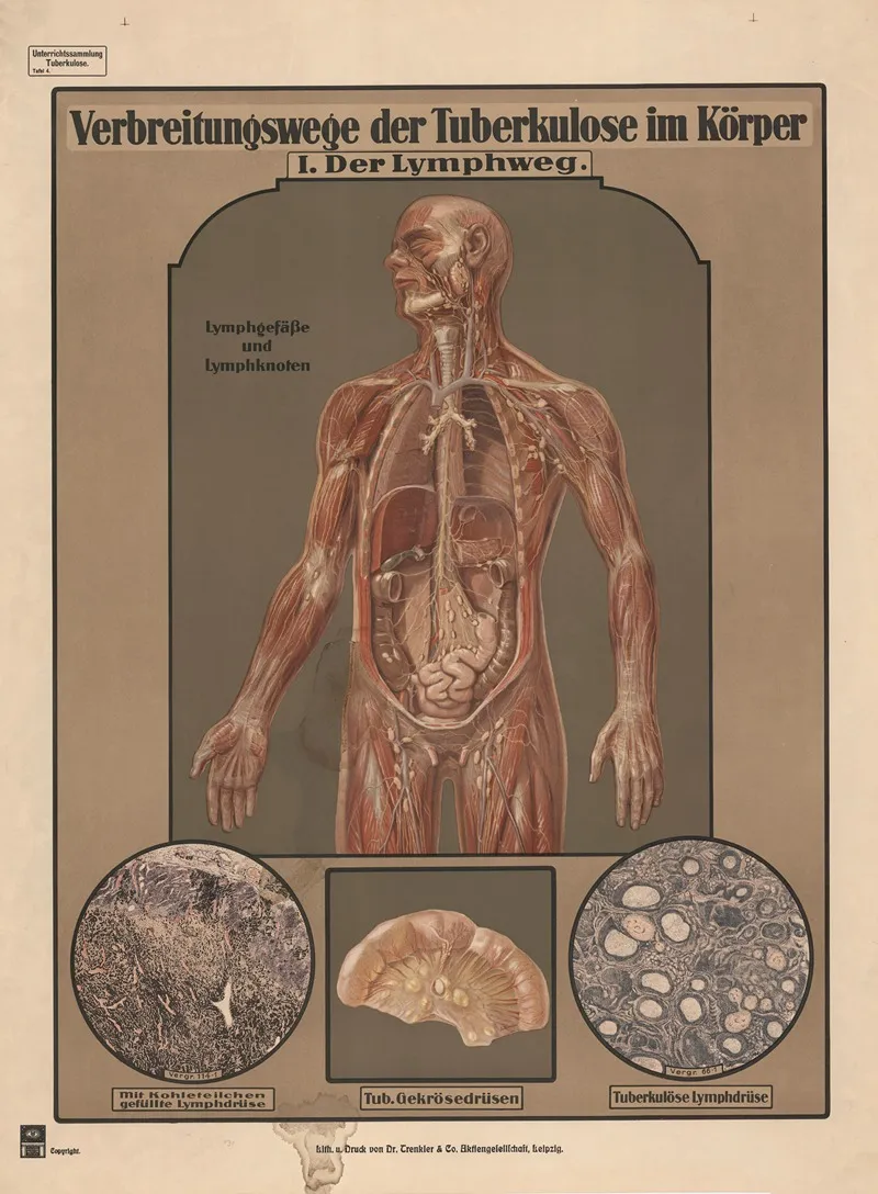 Routes Of Tuberculosis Transmission In The Body I The Lymphatic System