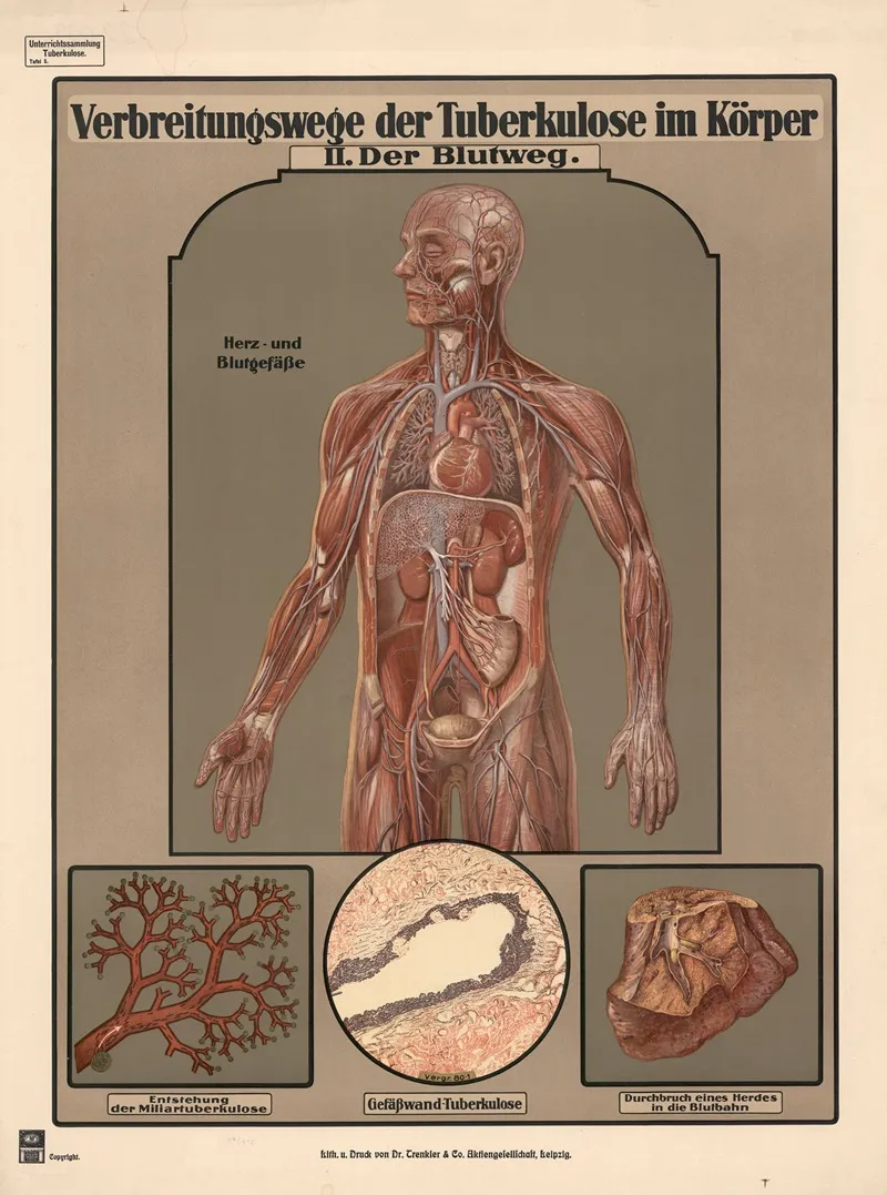 Routes Of Tuberculosis Transmission In The Body Ii The Bloodstream