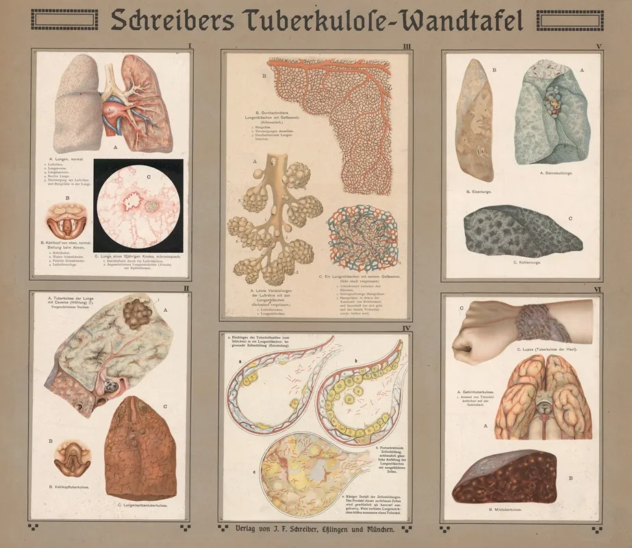 Schreibers Tuberculosis Table
