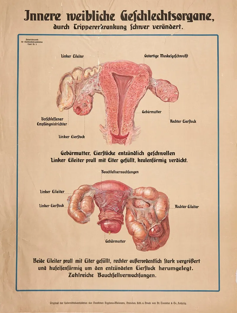 The Womans Internal Genitalia Are Severly Altered Due To Sexually Transmitted Diseases Gonorrhea