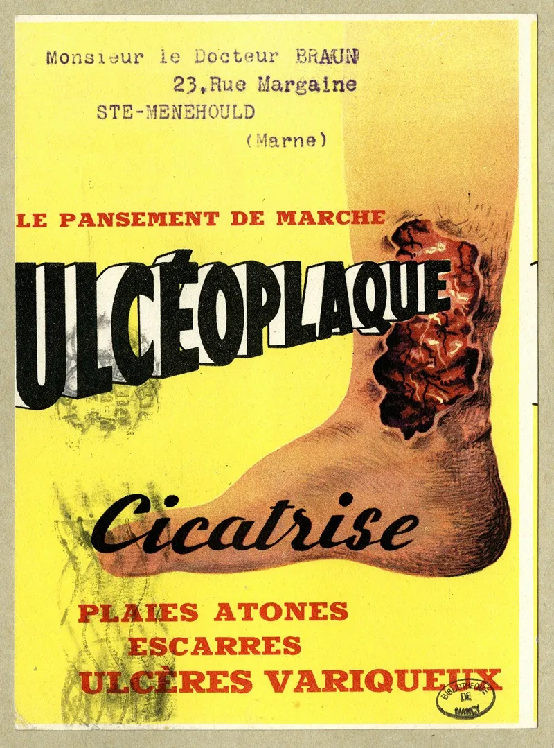 Ulceoplaque
