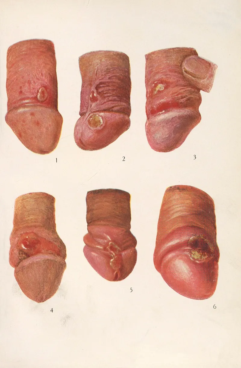 Venereal Diseases Syphilis Pl 01