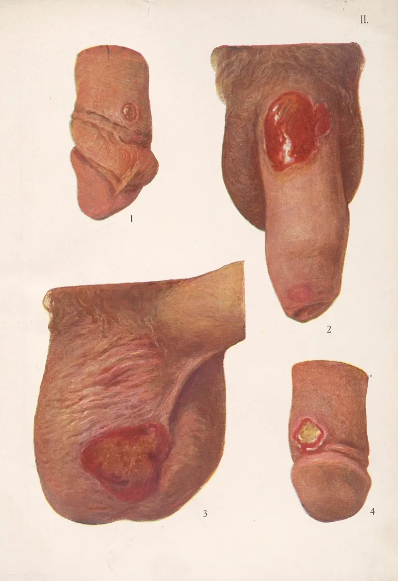 Venereal Diseases Syphilis Pl 02