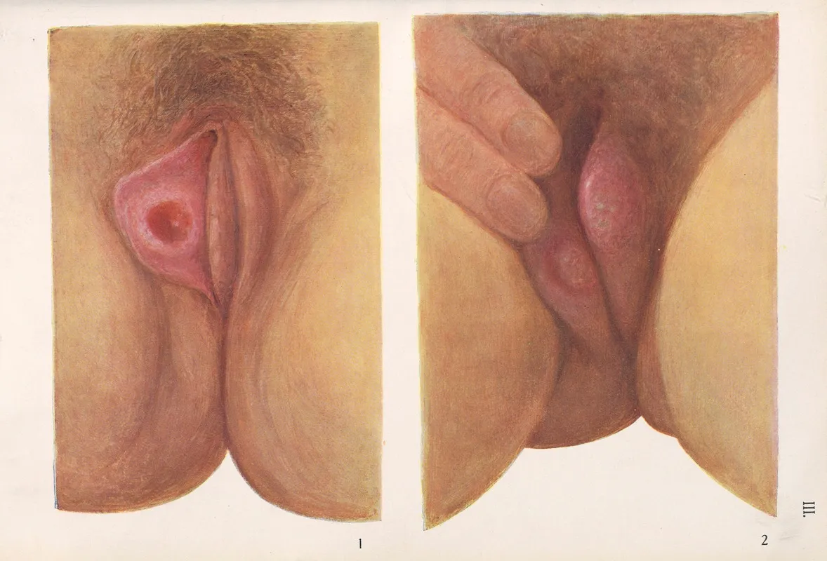 Venereal Diseases Syphilis Pl 03