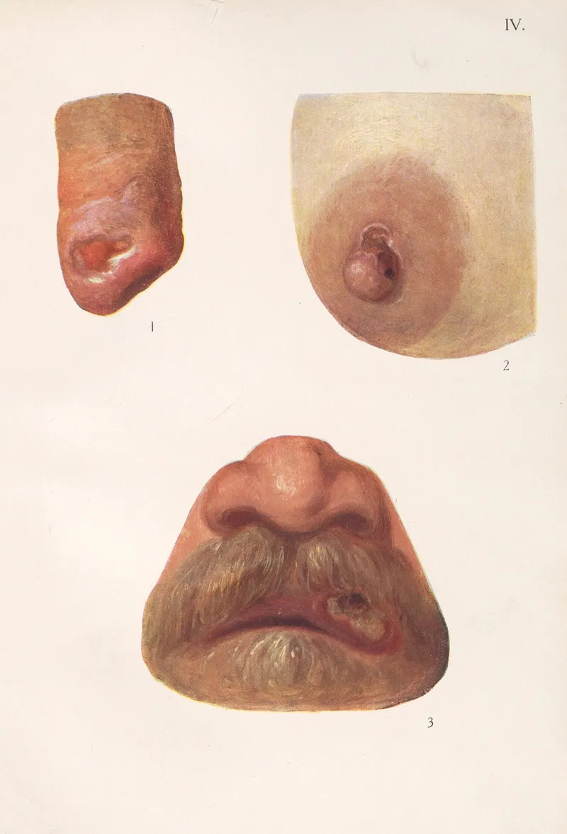 Venereal Diseases Syphilis Pl 04