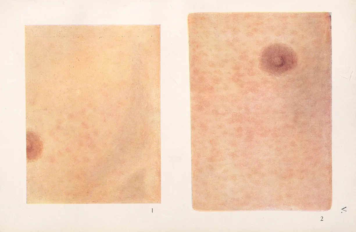 Venereal Diseases Syphilis Pl 05