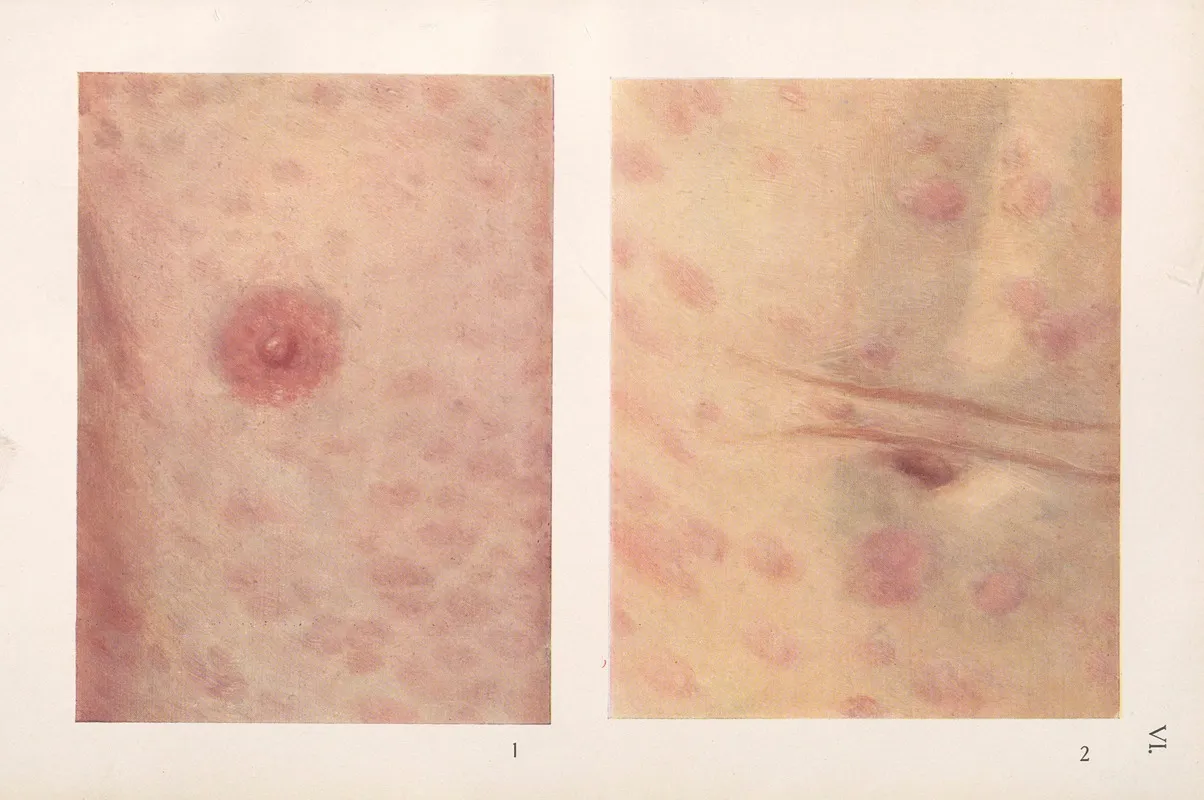 Venereal Diseases Syphilis Pl 06