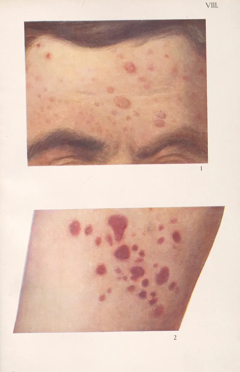 Venereal Diseases Syphilis Pl 08