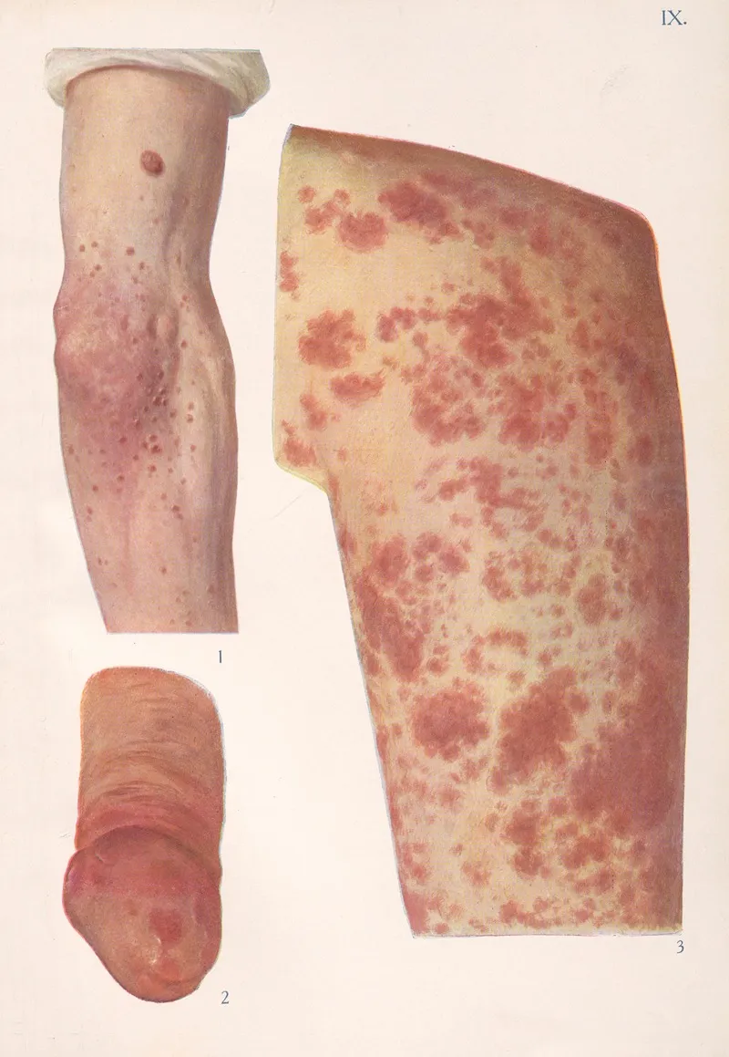 Venereal Diseases Syphilis Pl 09