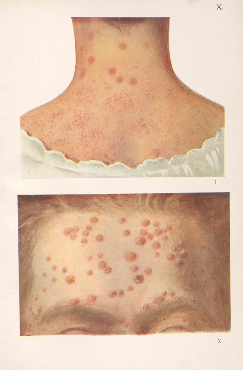 Venereal Diseases Syphilis Pl 10
