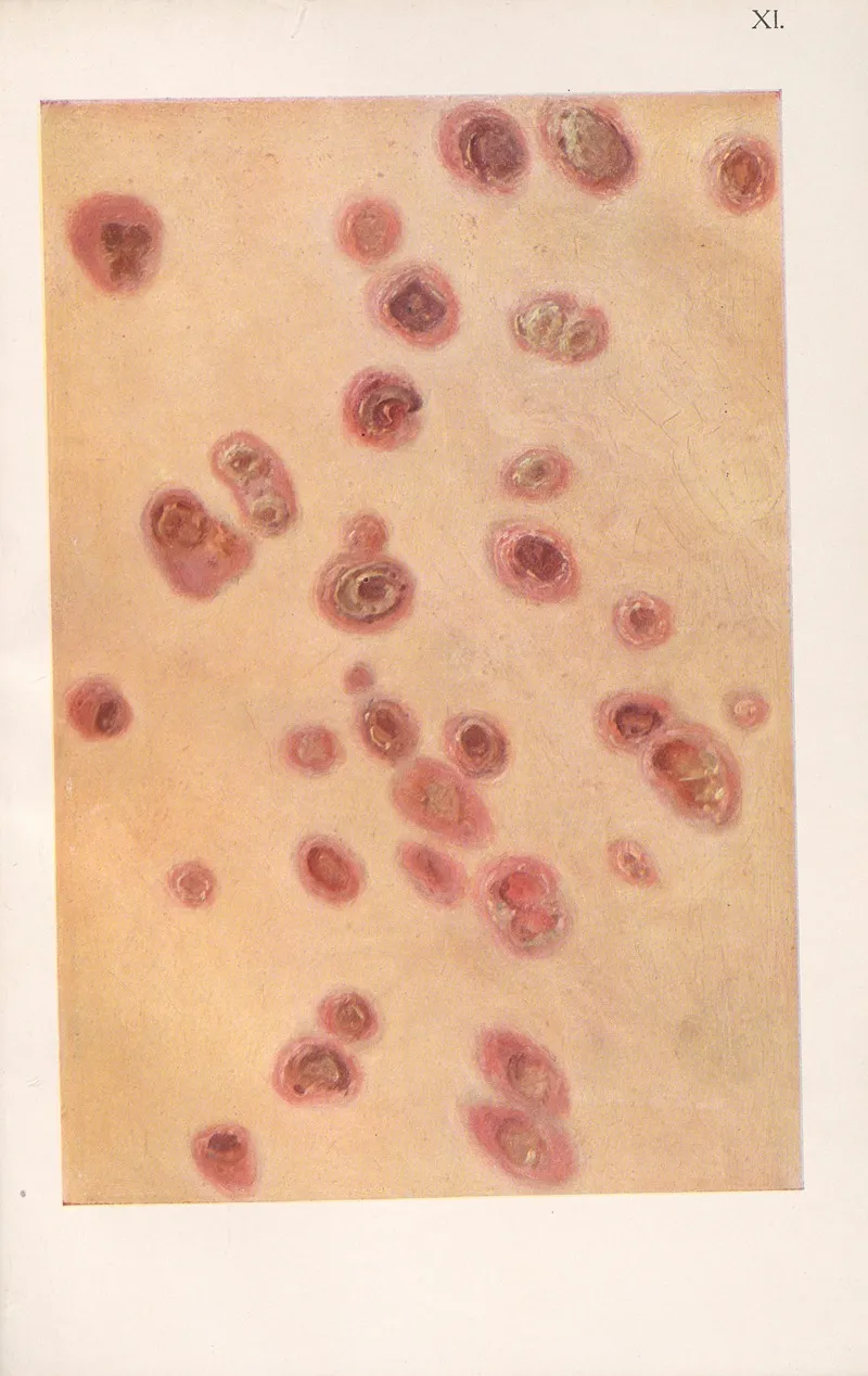 Venereal Diseases Syphilis Pl 11