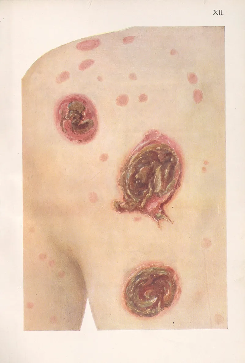 Venereal Diseases Syphilis Pl 12