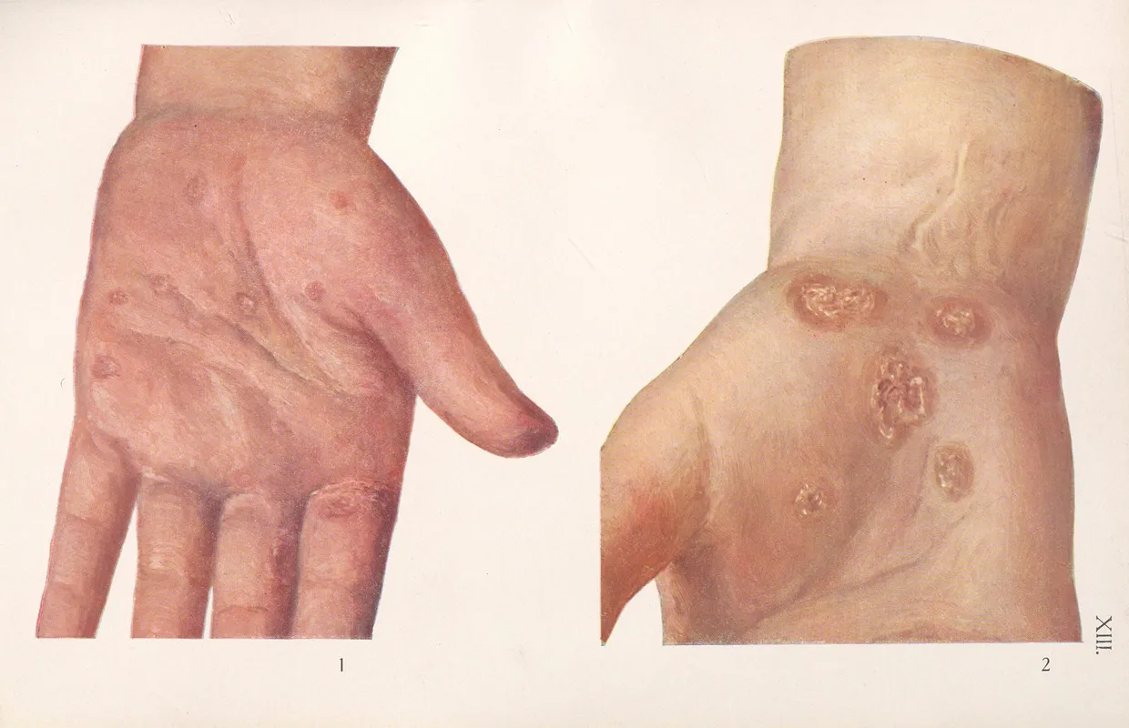 Venereal Diseases Syphilis Pl 13