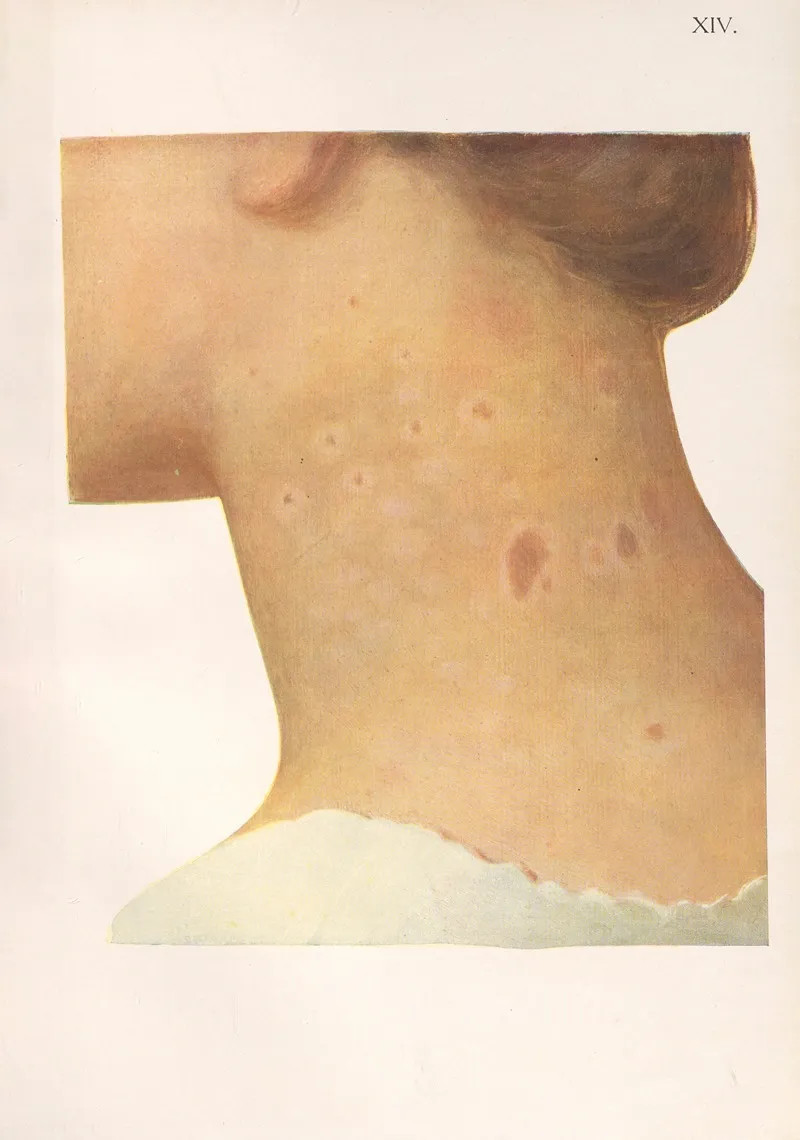 Venereal Diseases Syphilis Pl 14