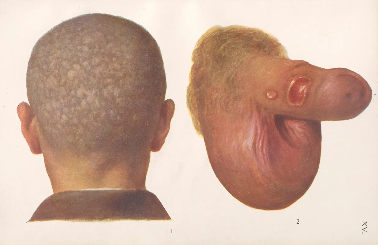 Venereal Diseases Syphilis Pl 15