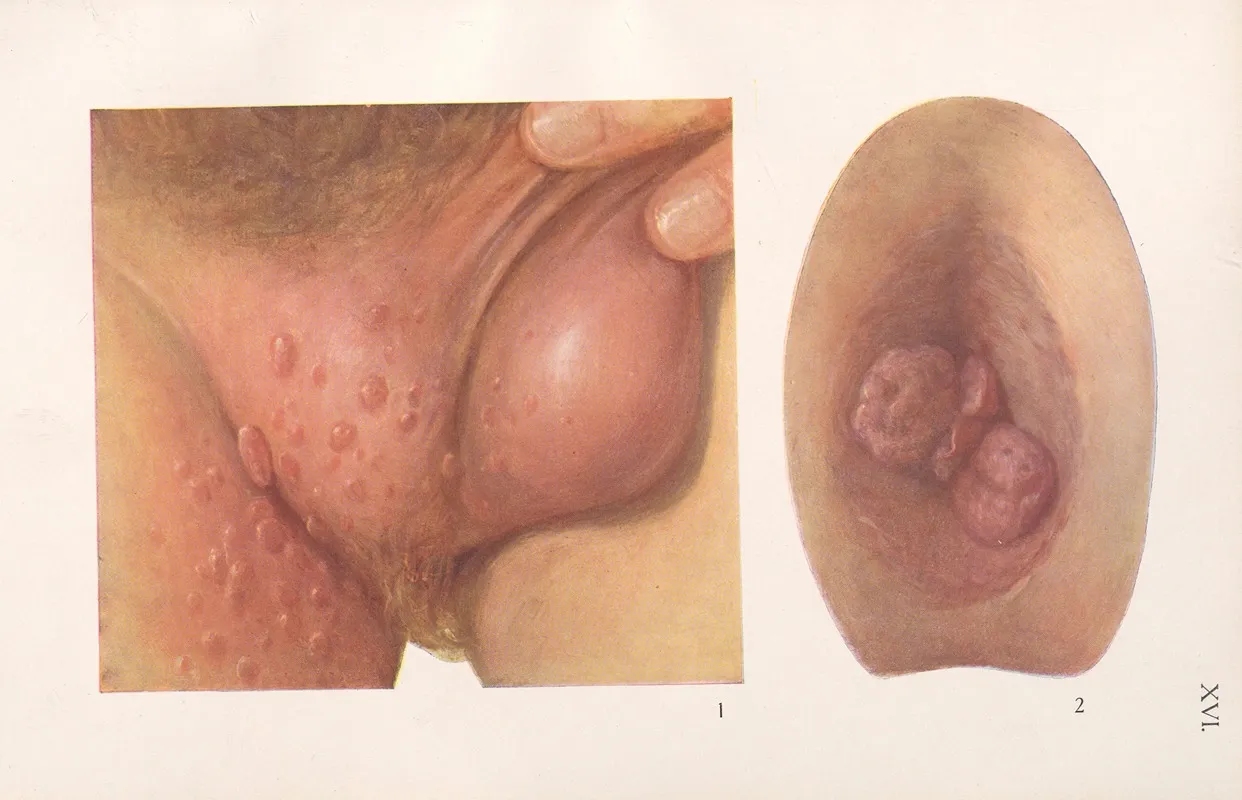 Venereal Diseases Syphilis Pl 16