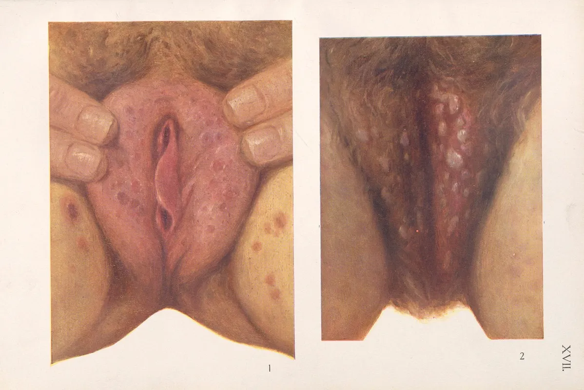 Venereal Diseases Syphilis Pl 17