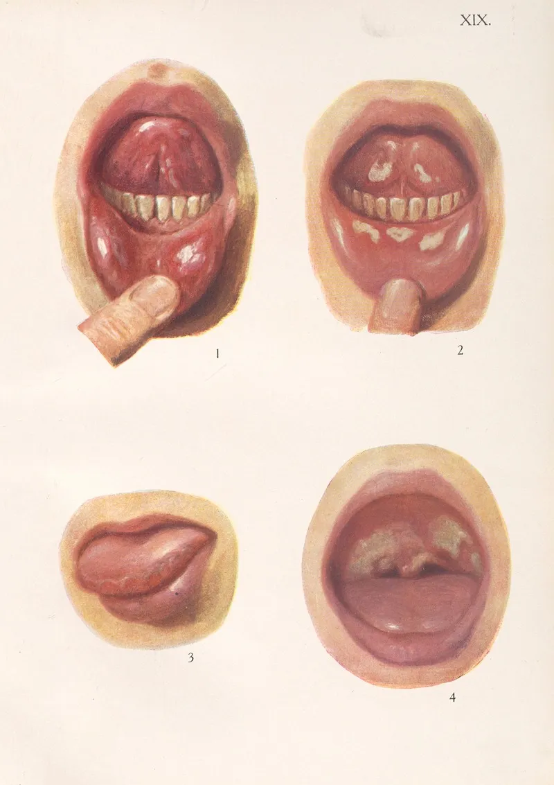 Venereal Diseases Syphilis Pl 19