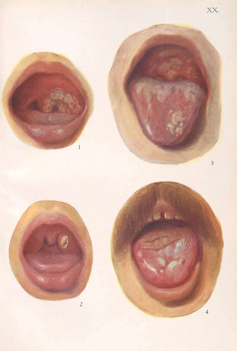 Venereal Diseases Syphilis Pl 20