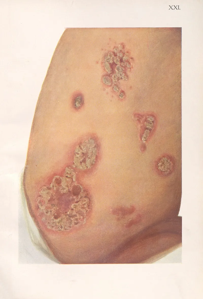 Venereal Diseases Syphilis Pl 21