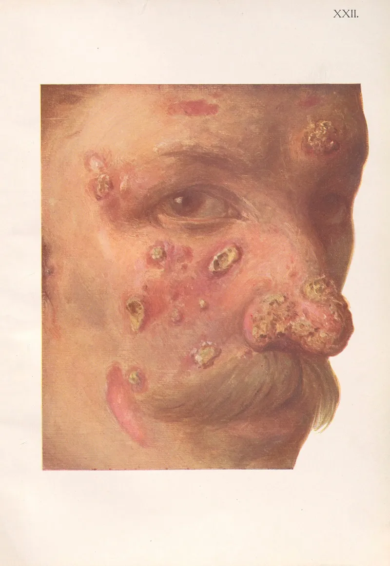 Venereal Diseases Syphilis Pl 22
