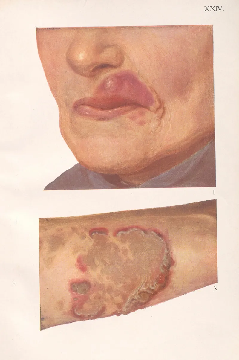 Venereal Diseases Syphilis Pl 24
